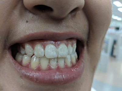 fluorosis gigi