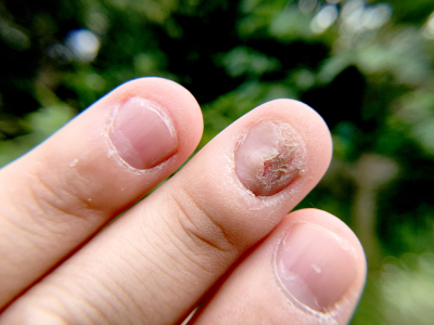 gambar infeksi jamur kuku atau tinea unguium