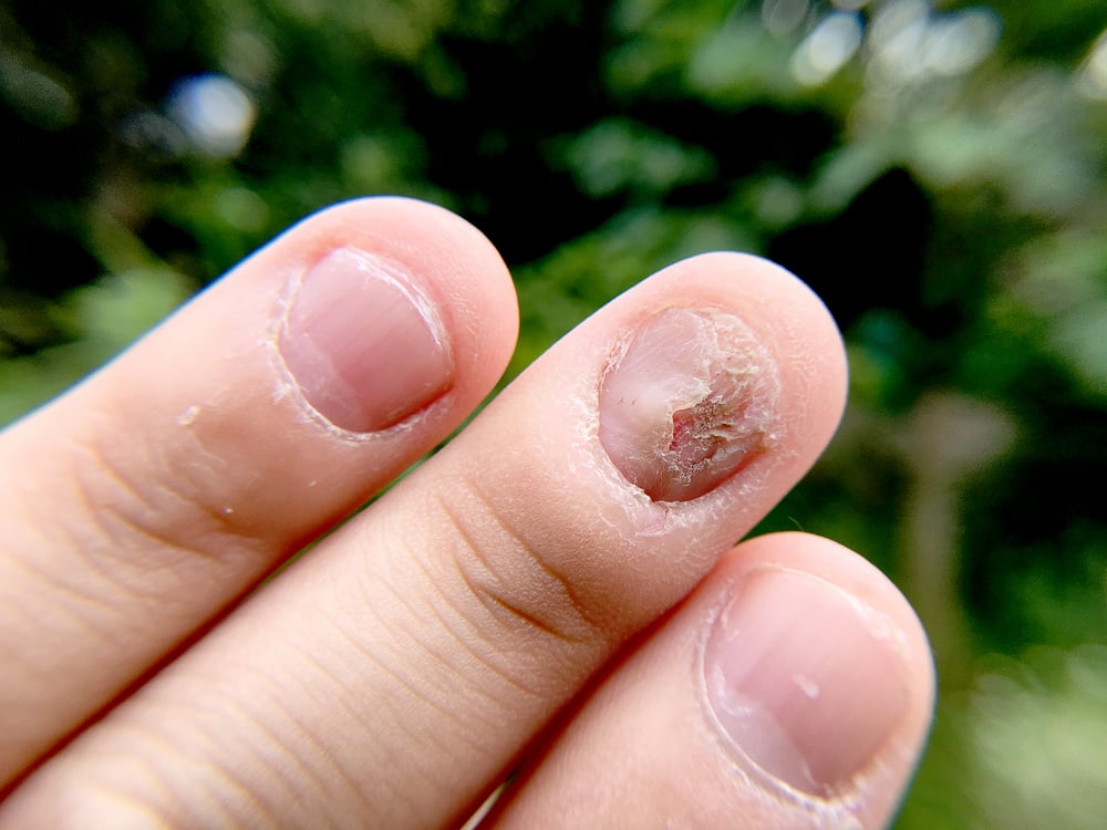 gambar infeksi jamur kuku atau tinea unguium