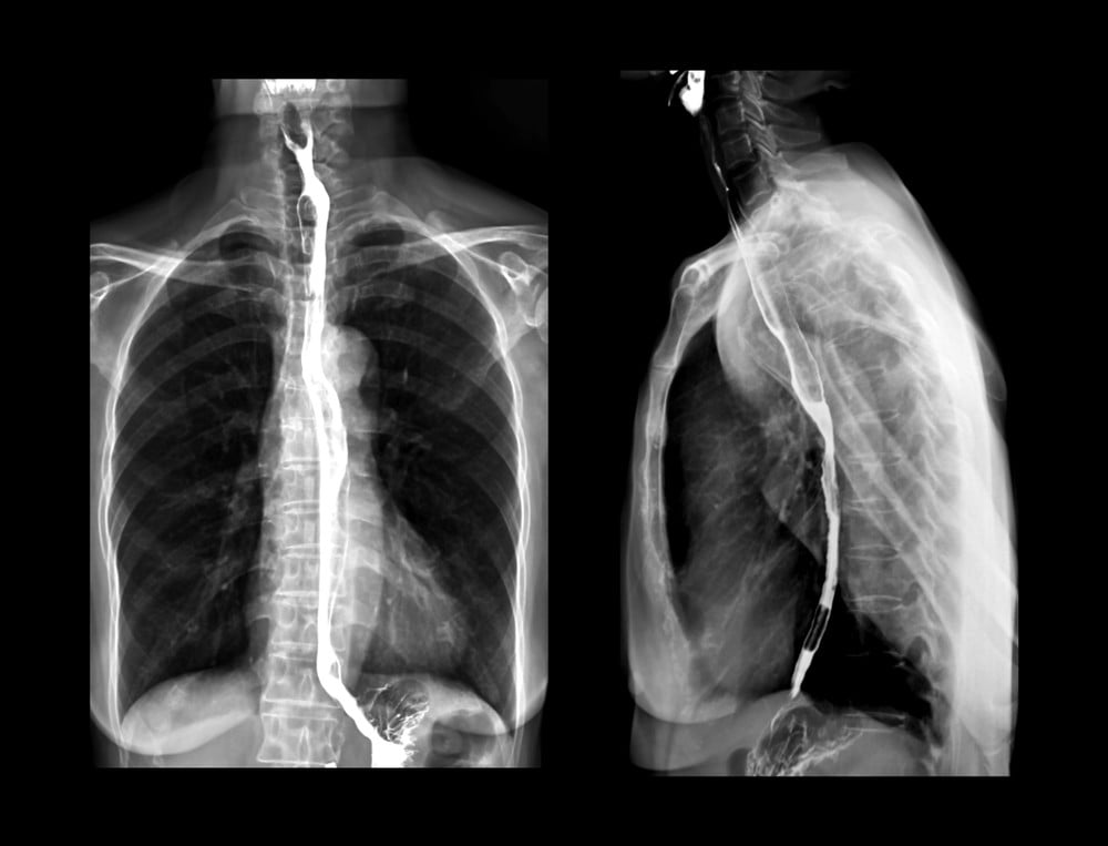 Barium Swallow