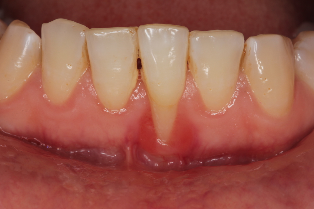 Mengenal Resesi Gingiva (Gusi Turun) dan Pengobatannya