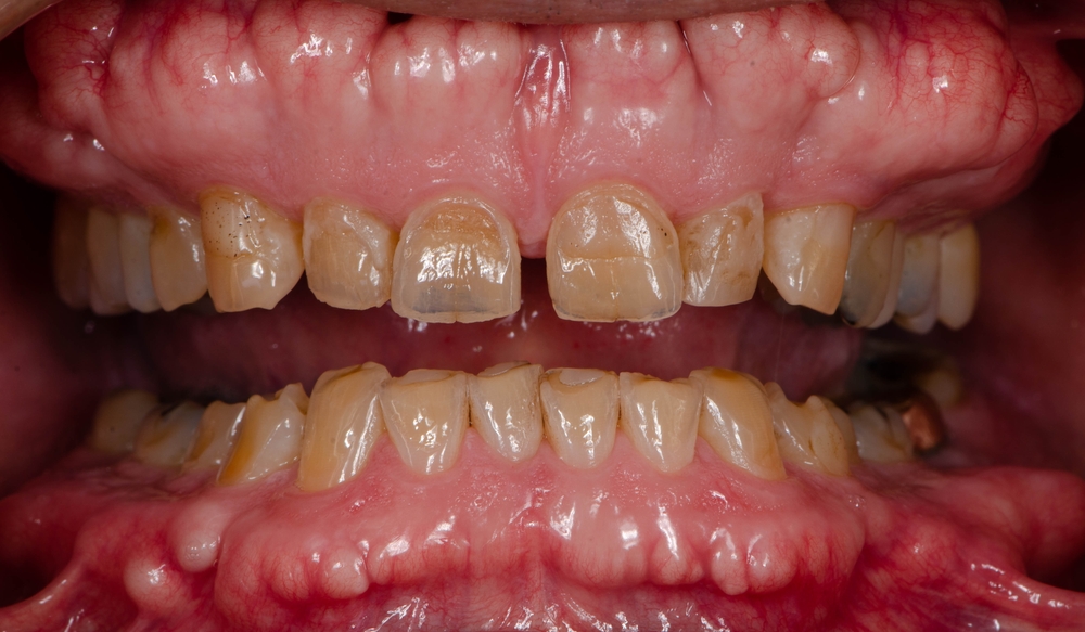 Erosi Gigi (Dental Erosion)