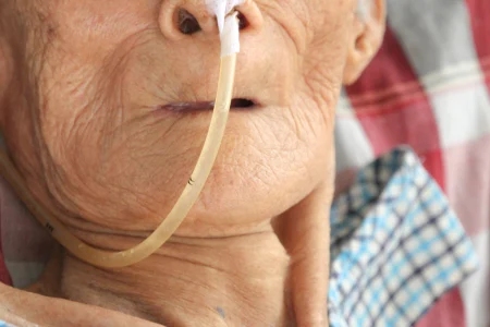 Pemasangan NGT (Nasogastric Tube)