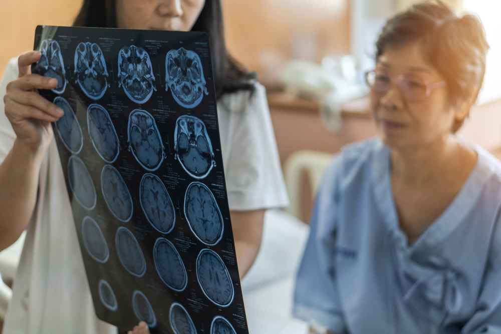 13 Komplikasi yang Mungkin Terjadi Akibat Stroke