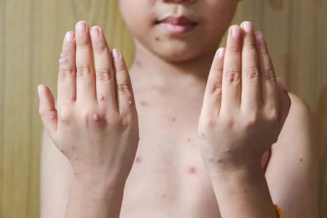 cacar-air-pada-anak