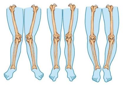 Mengenal Bentuk Kaki X, Penyebab serta Cara Mengatasinya