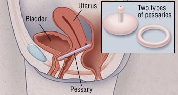 pessary vagina
