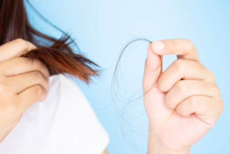 Ketombe Bikin Rambut Rontok, Ini Penyebab dan Penanganannya