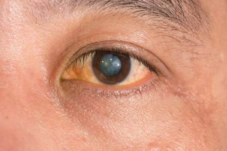 Mengupas Seputar Katarak Kortikal, Ketika Lensa Mata Menjadi Keruh