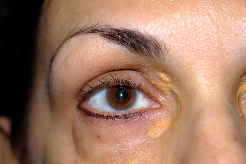 Mengenal Xanthelasma, Gumpalan Lemak yang Muncul di Sekitar Kelopak Mata