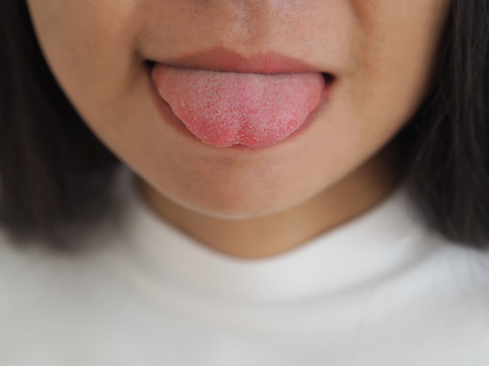 obat sariawan di lidah