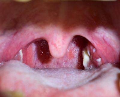 Detritus tonsil