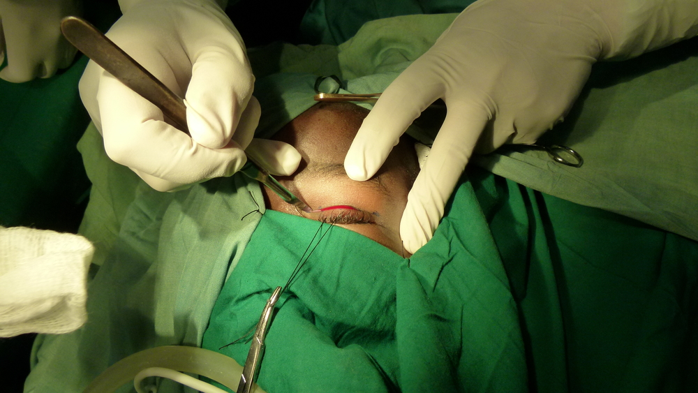 Operasi kelopak mata