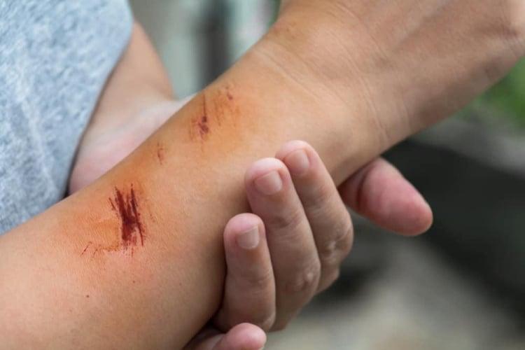 Jenis Luka pada Kulit serta Penanganannya