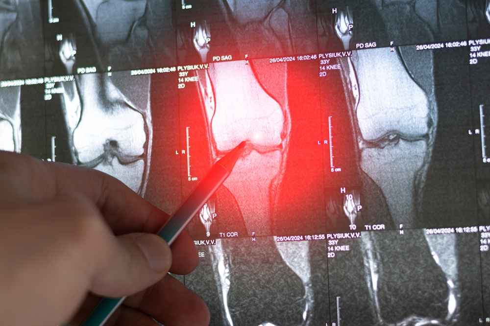 Ewing’s Sarcoma