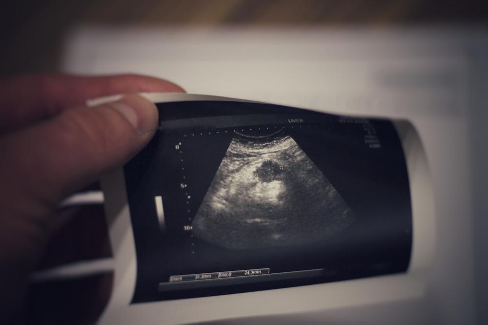 Pilihan Makanan yang Tepat untuk Penderita Kanker Pankreas