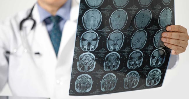 Bebagai Jenis Operasi untuk Kanker Otak dan Efek Sampingnya