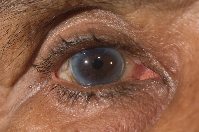 Iridotomy, Prosedur Pencegahan Glaukoma Sudut Tertutup