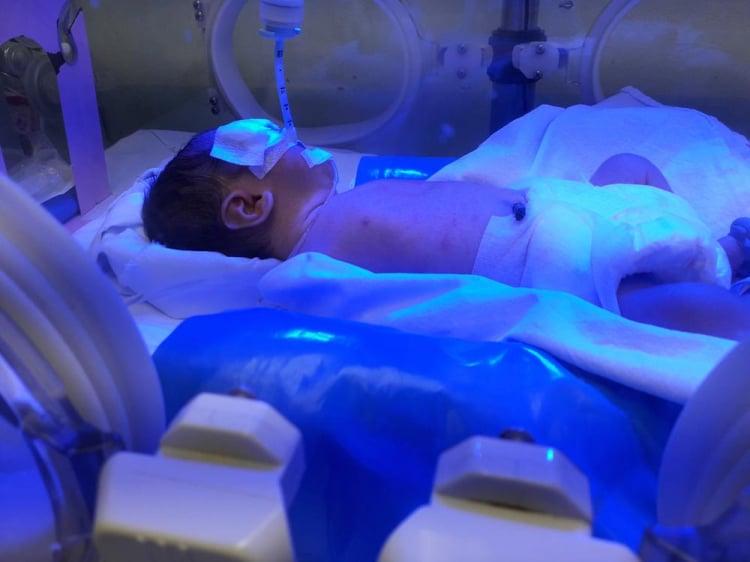 Berapa Kadar Bilirubin Normal pada Bayi Baru Lahir?