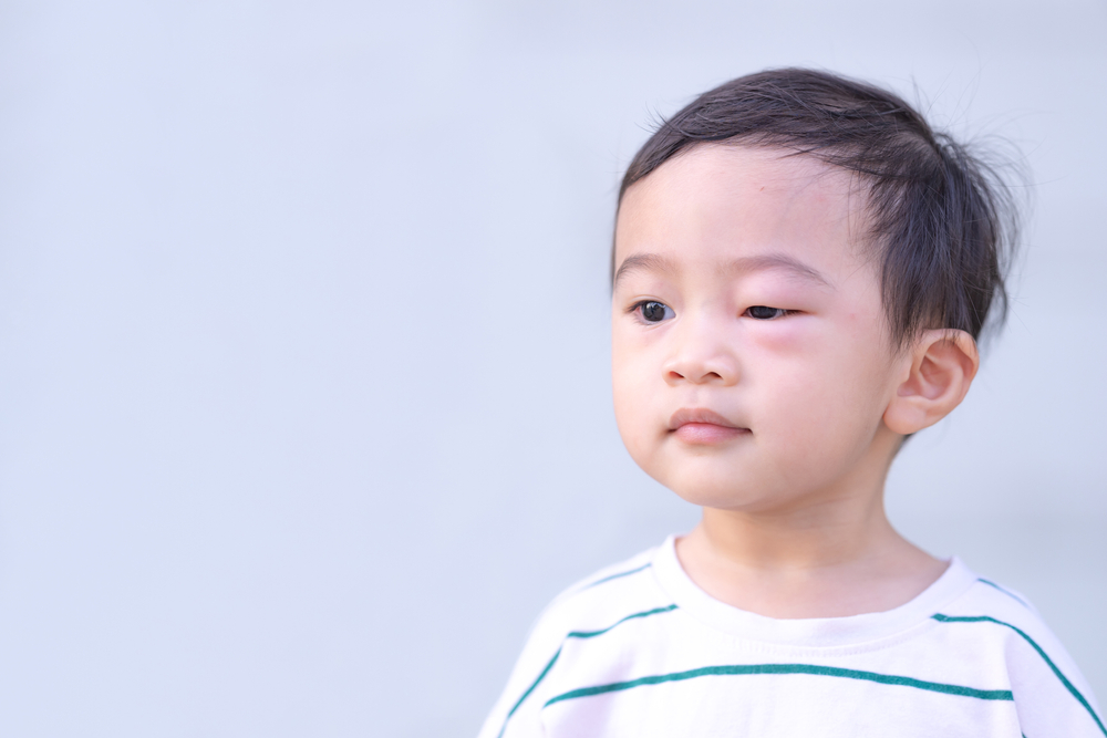 4 Penyebab Mata Bengkak pada Anak dan Cara Menyembuhkannya