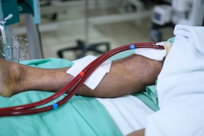 Mengenali Critical Limb Ischemia (CLI), Komplikasi dari Penyakit Arteri Perifer