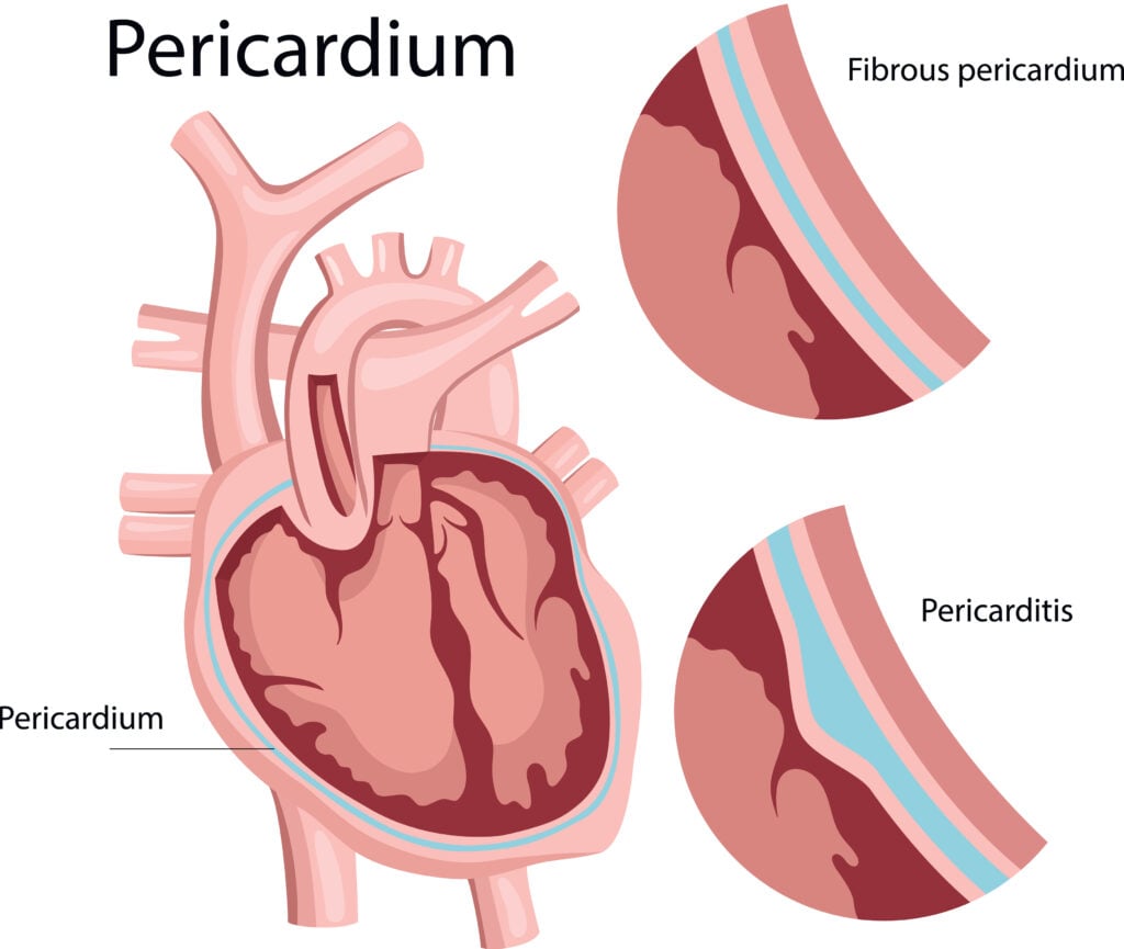 perikaridum jantung