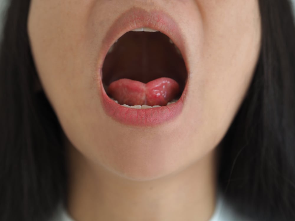 penyakit lidah