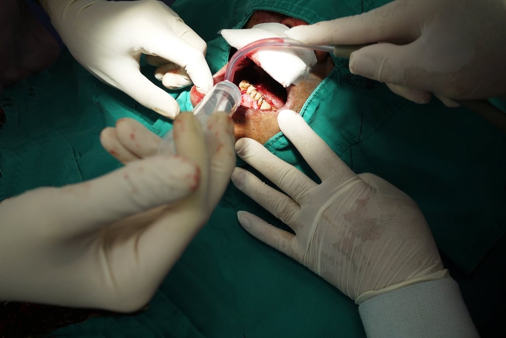 operasi bedah mulut