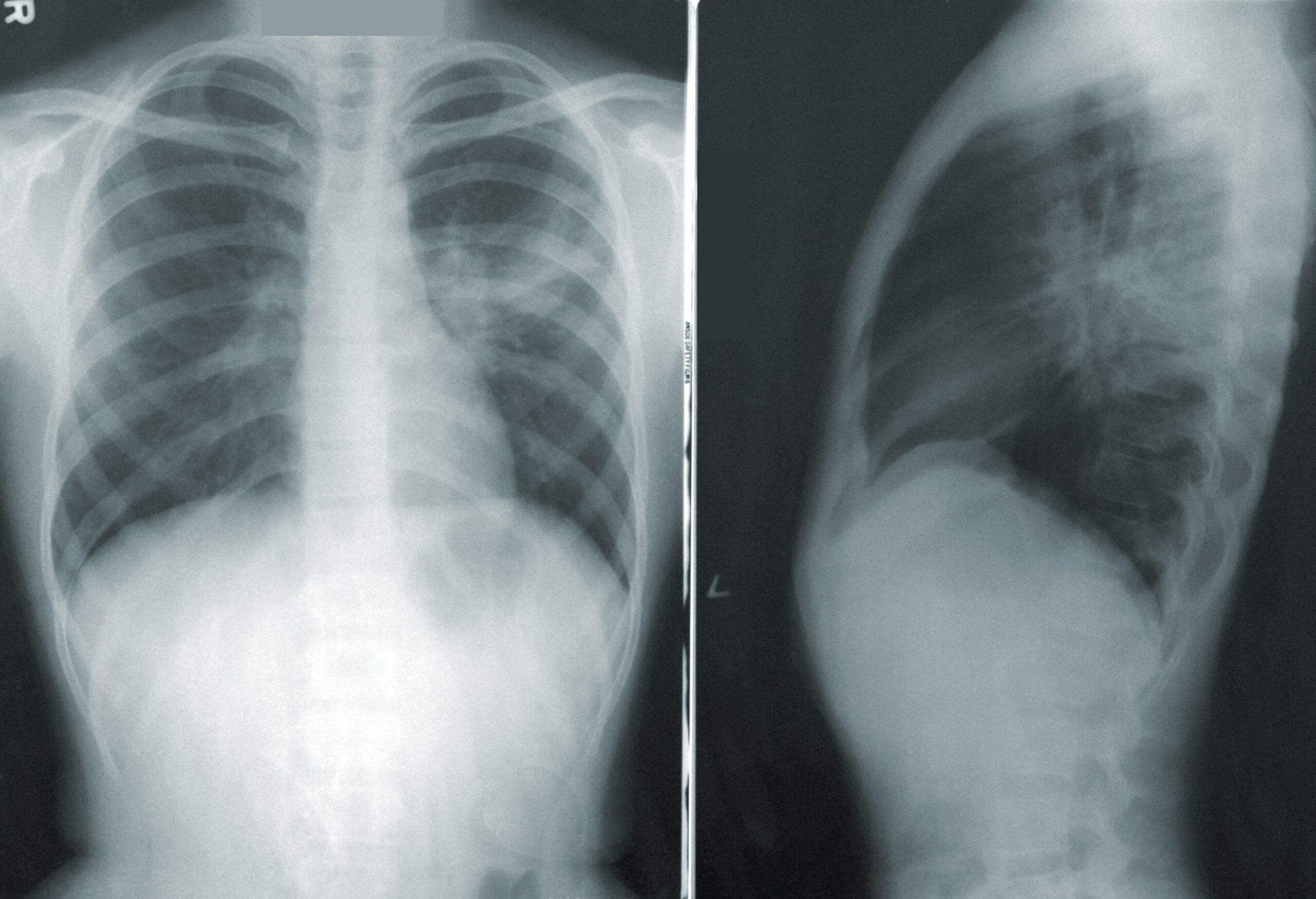 Apa Perbedaan Penyakit Asma dan Pneumonia?