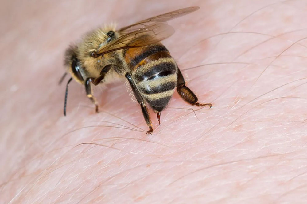 alergi-sengatan-lebah