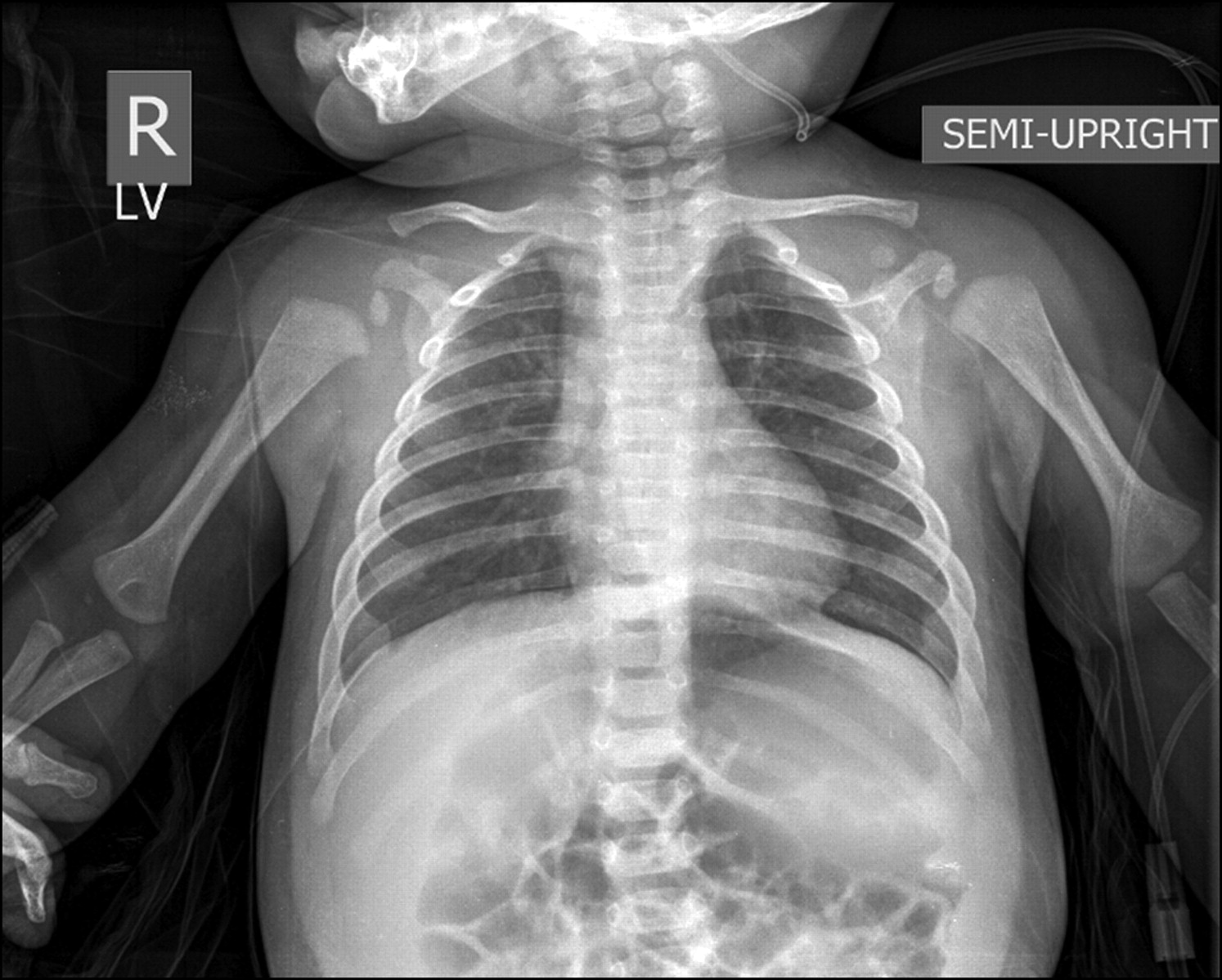 Berbagai Komplikasi yang Bisa Ditimbulkan dari Bronkiolitis