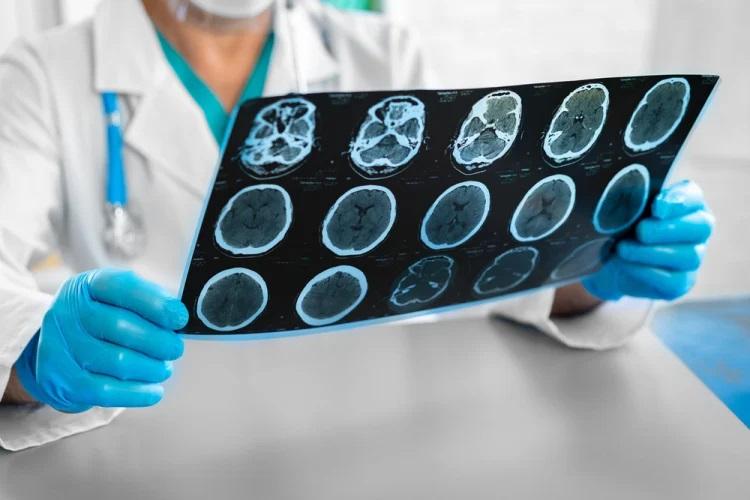 Mengenal Cairan Serebrospinal dan Fungsinya untuk Tubuh