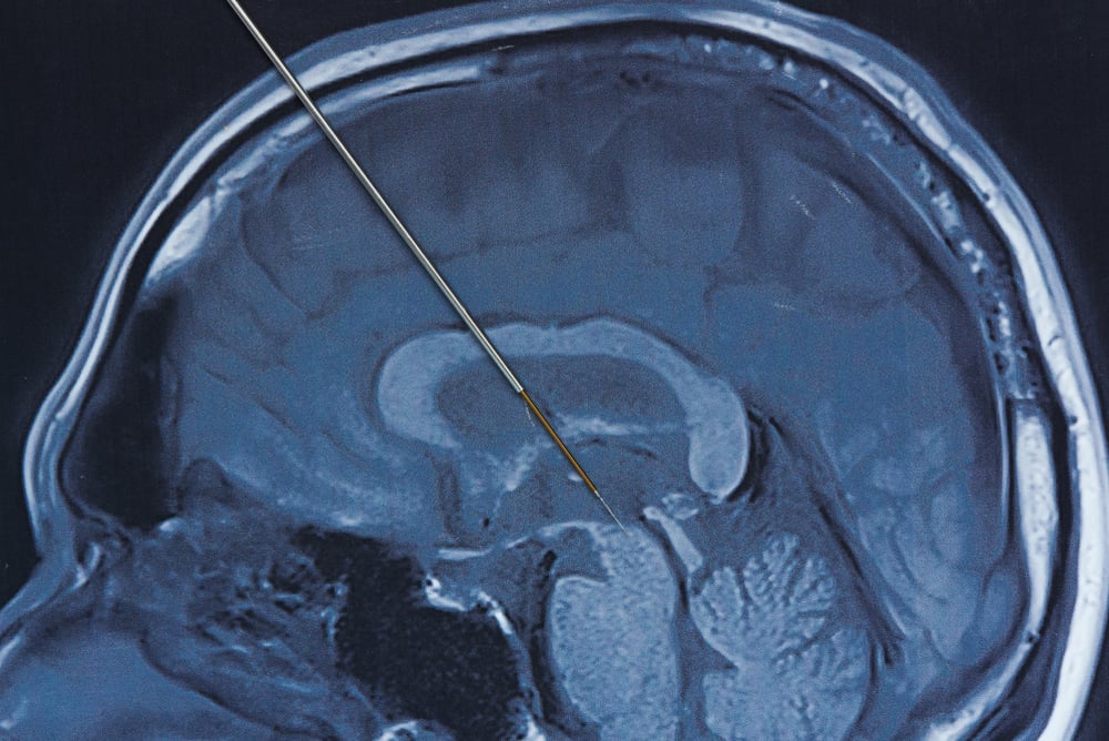 Prosedur Deep Brain Stimulation untuk Mengobati Penyakit Parkinson