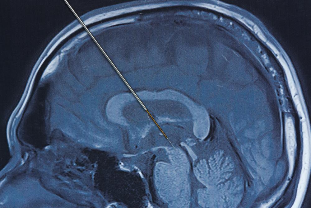 Prosedur Deep Brain Stimulation untuk Mengobati Penyakit Parkinson