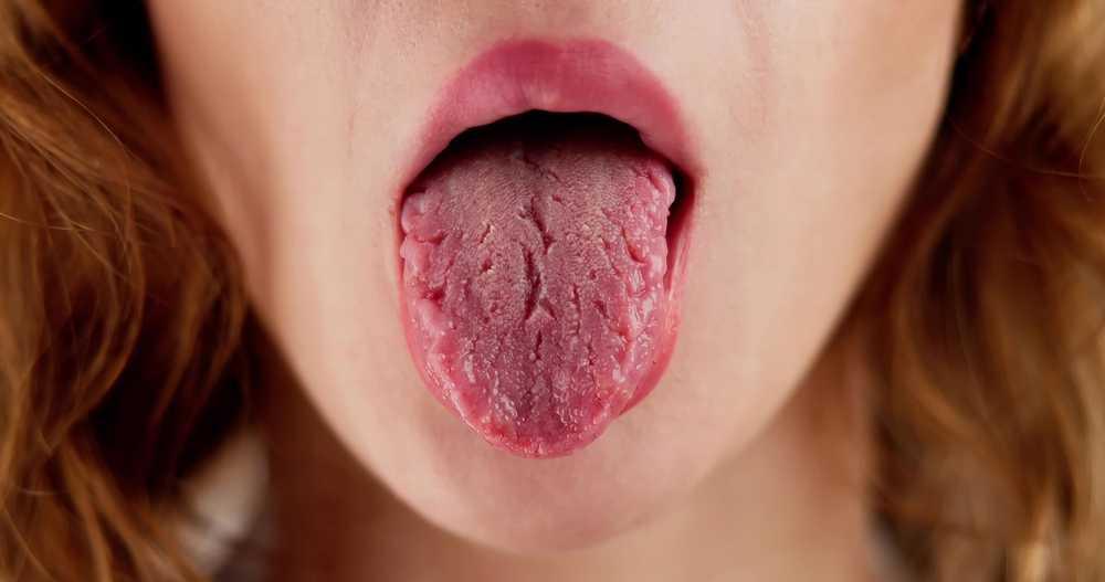 6 Penyebab Lidah Pecah Belah dan Cara Mengatasinya