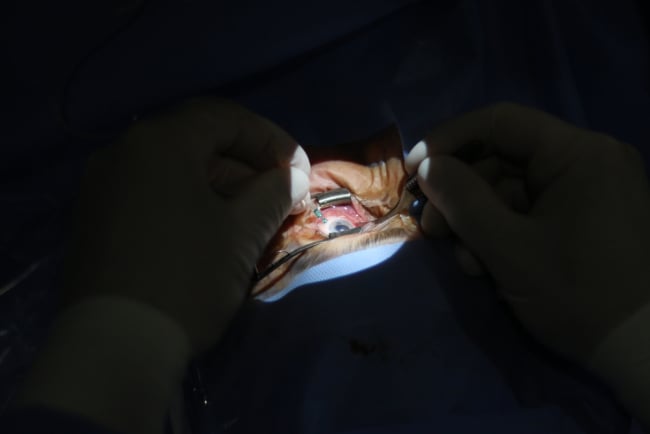 Vitrektomi, Prosedur Operasi Mata untuk Memperbaiki Retina