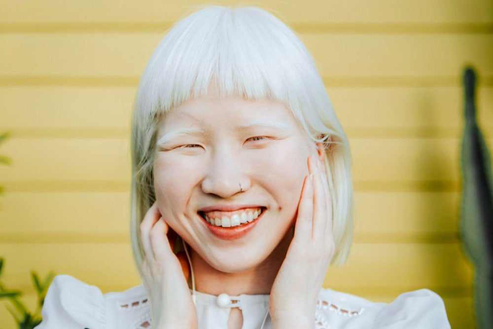Berbagai Komplikasi pada Albino yang Perlu Diwaspadai