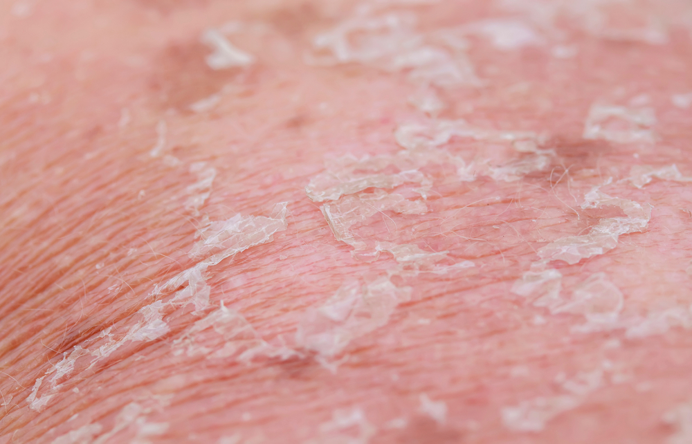 Dermatitis Neglecta, Kenali Gejala hingga Pengobatannya