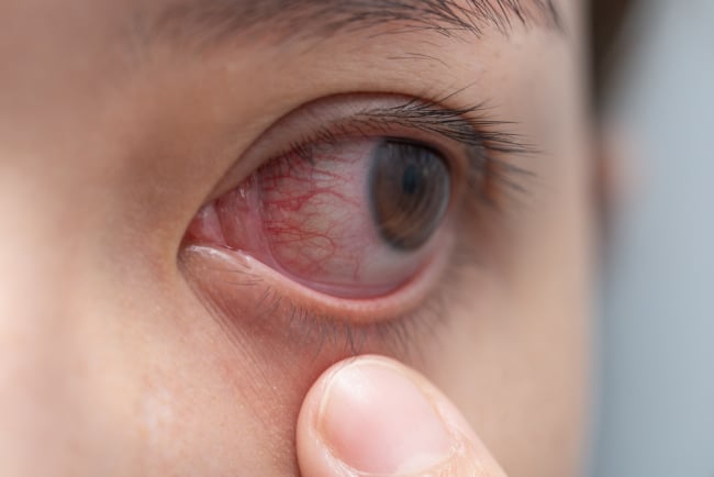 Mengulik Penyebab dan Cara Mengatasi Urat Mata Merah