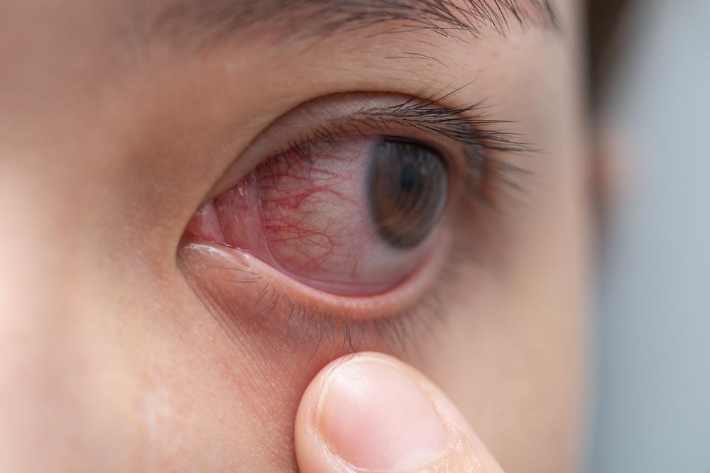 Mengulik Penyebab dan Cara Mengatasi Urat Mata Merah