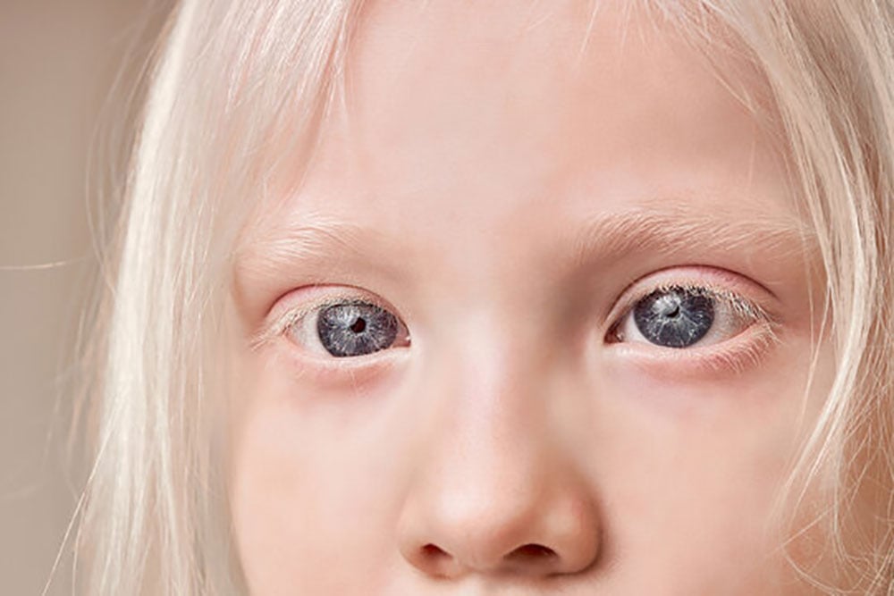 komplikasi mata albino albinisme
