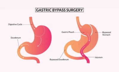 ilustrasi operasi gastric bypass