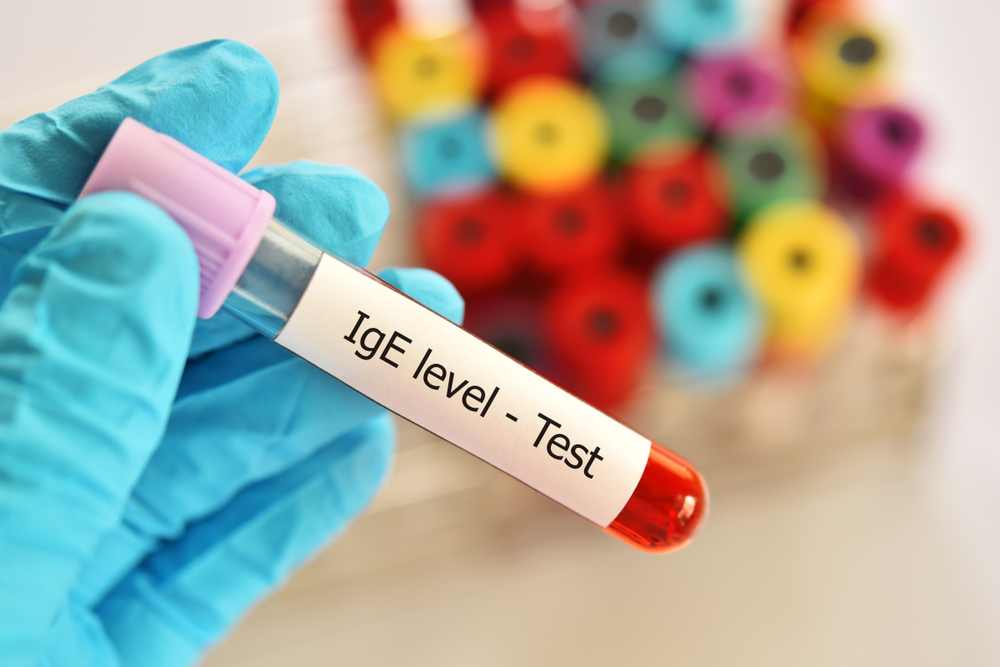 Tes IgE Total untuk Mengetahui Kemungkinan Alergi
