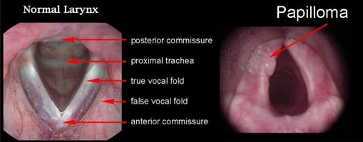 papilloma comparasion (center for voice and swallowing)