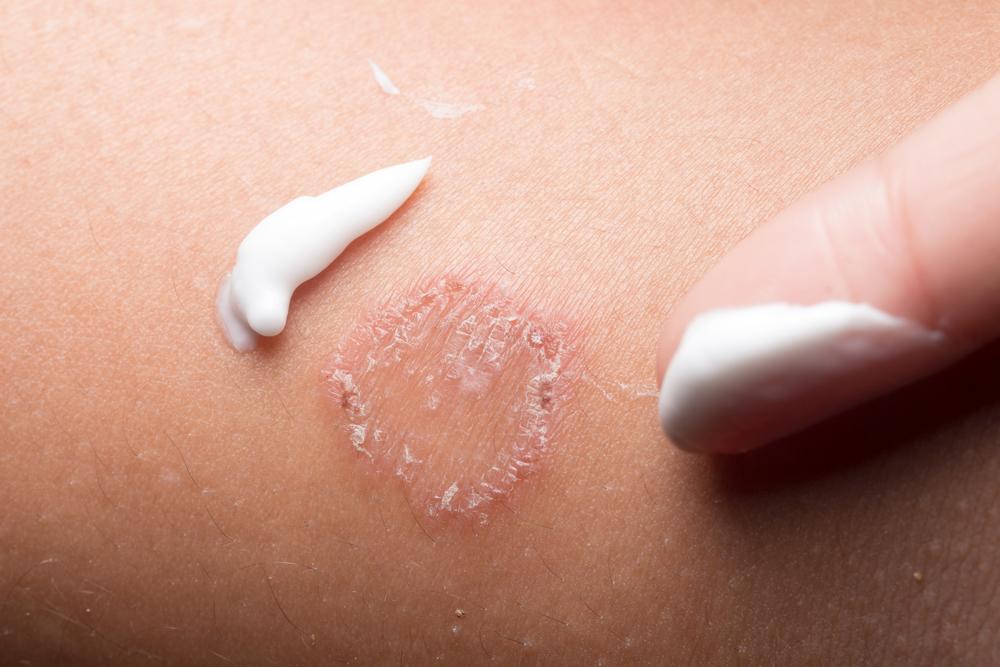 Mengenal Tanda-Tanda Infeksi Jamur pada Kulit akan Sembuh