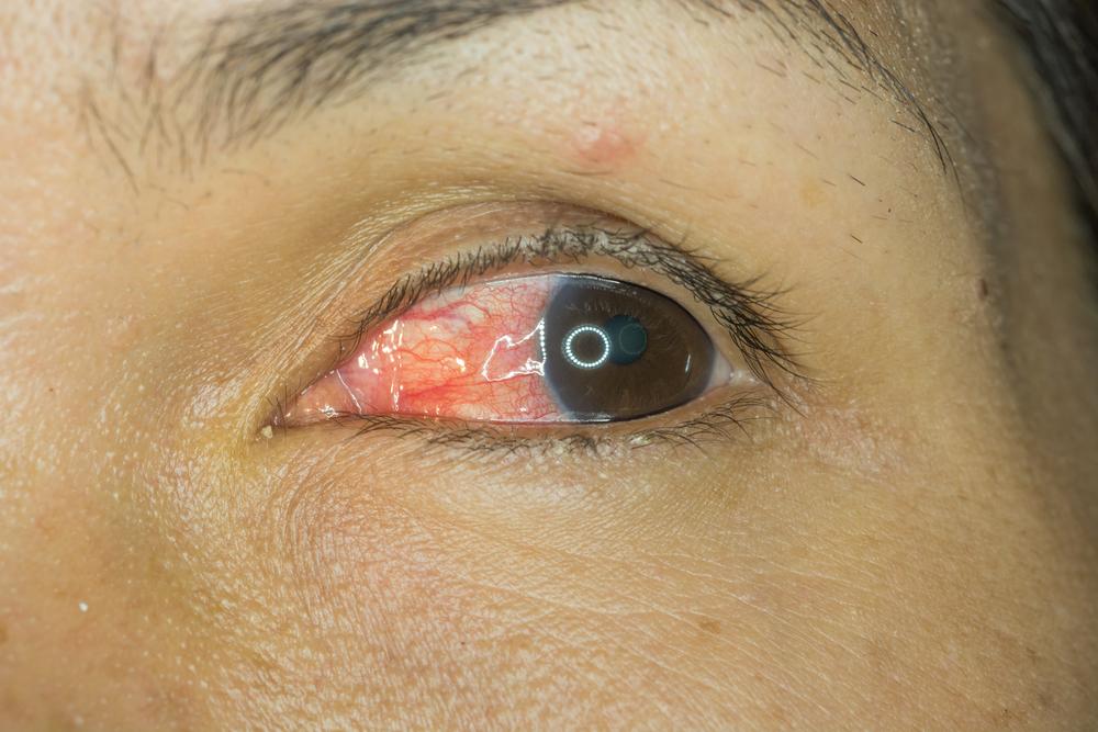 Skleritis, Peradangan pada Bagian Putih Mata Bernama Sklera