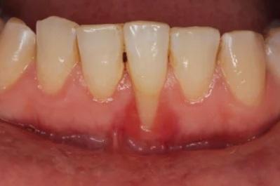Resesi Gingiva