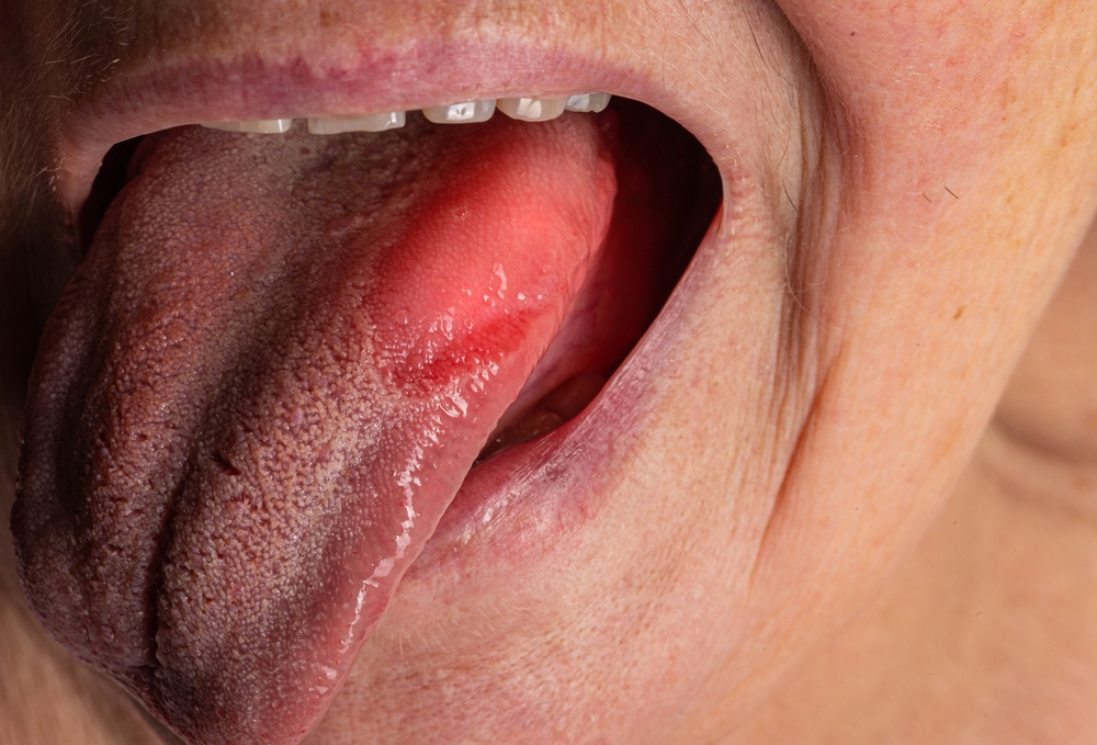 glossitis-lidah-bengkak-sakit