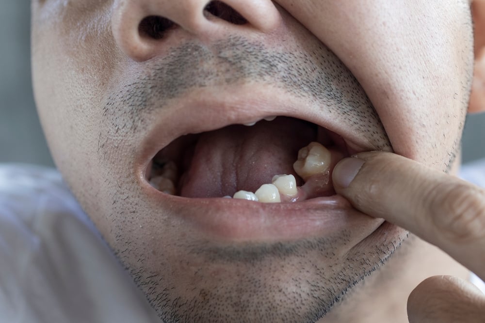 3 Solusi untuk Mengatasi Gigi Ompong pada Usia Muda