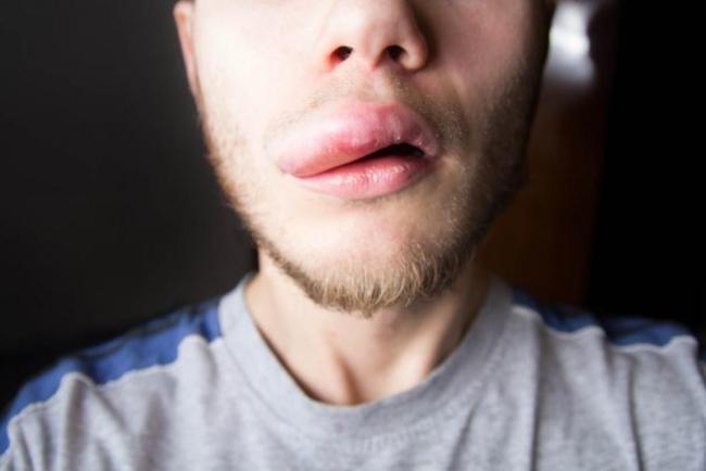4 Penyebab Bibir Bengkak Tiba-Tiba yang Umum